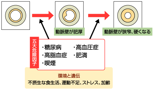 動脈 硬化 と は